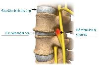 Trị đau thắt lưng thấp có nguồn gốc đĩa đệm
